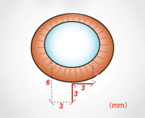 l_shaped_scleral_tunnel