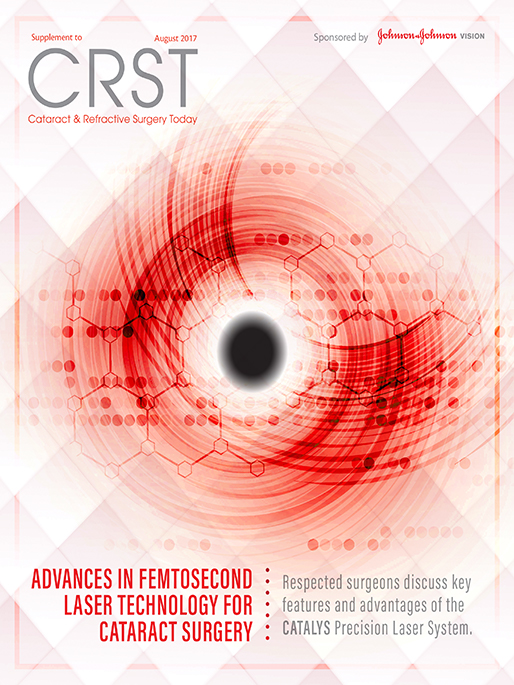 Advances in Femtosecond Laser Technology for Cataract Surgery