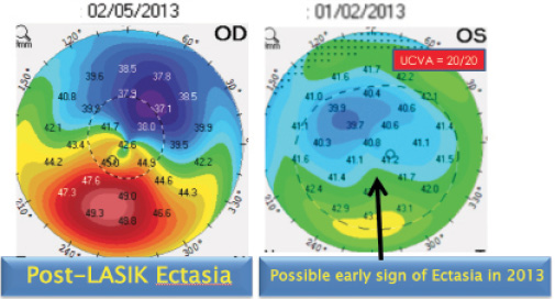 CRSToday Early Identification of Patients With