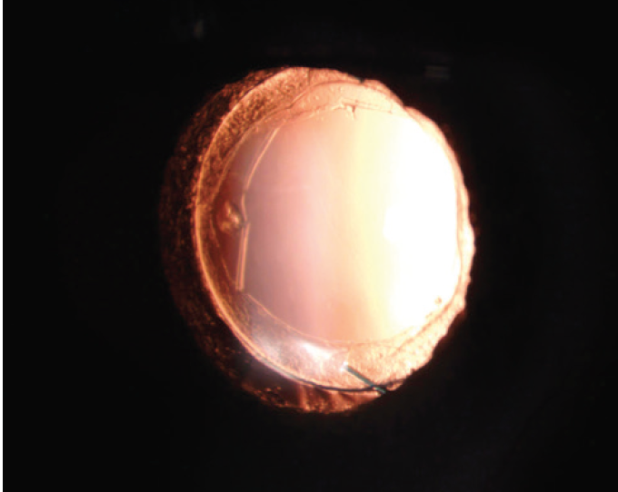 Does cataract surgery cause halos Info