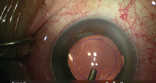 CRSToday | Refractive Cataract Surgery in a Glaucoma Practice