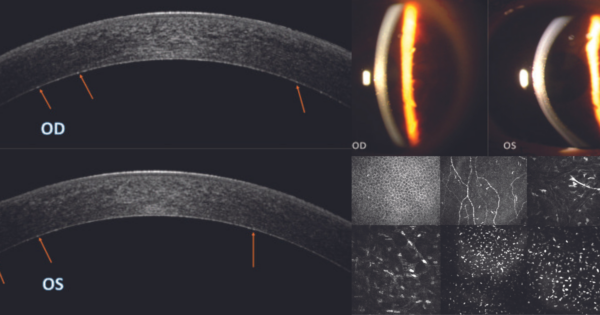 CRSToday | Punctiform And Polychromatic Pre-Descemet Corneal Dystrophy