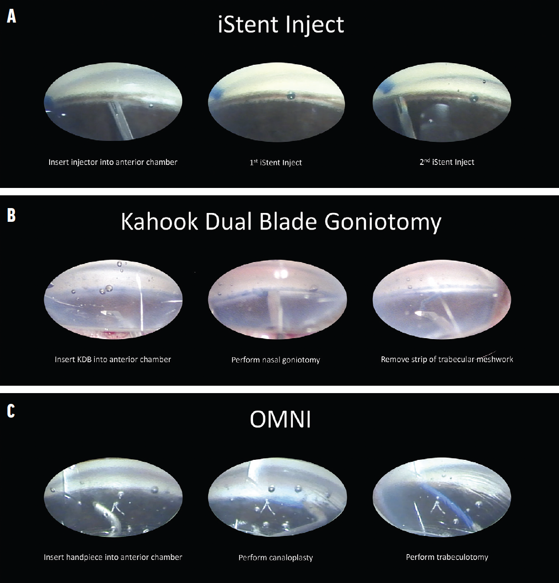 CRSToday | Combined Management Of Cataract And Glaucoma