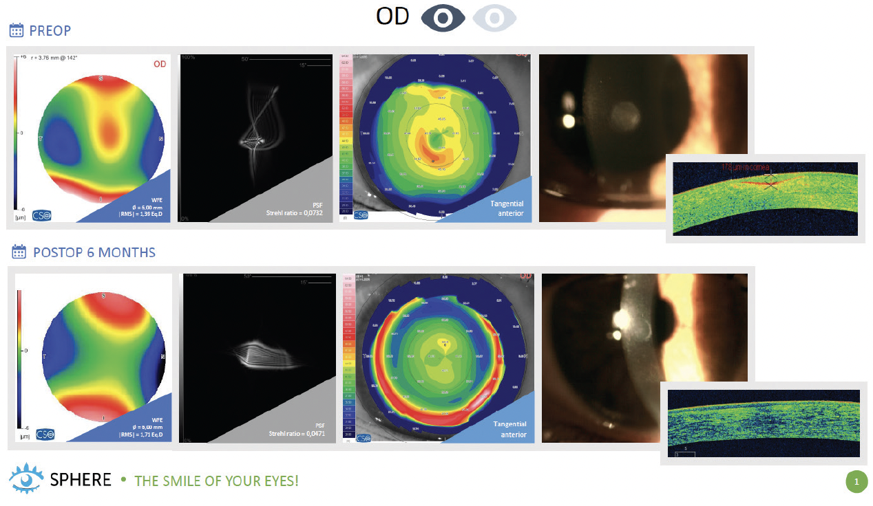 CRSToday  Customized Treatments for Patients With Poor Visual Acuity