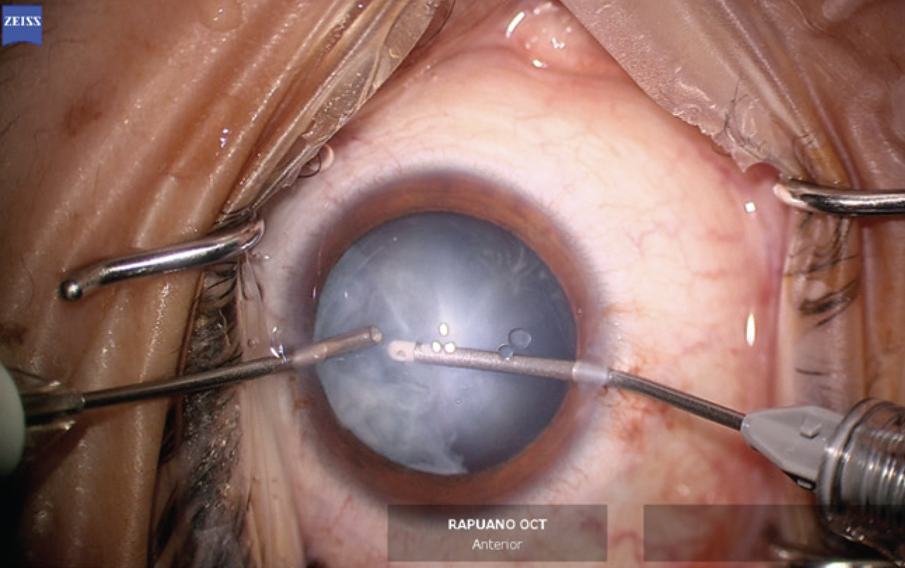 Cataract Surgery in Silicone Oil Eyes – Cataract Coach™